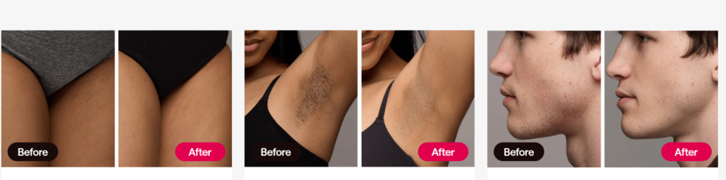 before and after using ulikeX. Alt Text: "Hair reduction progress with Ulike X in 2 weeks."